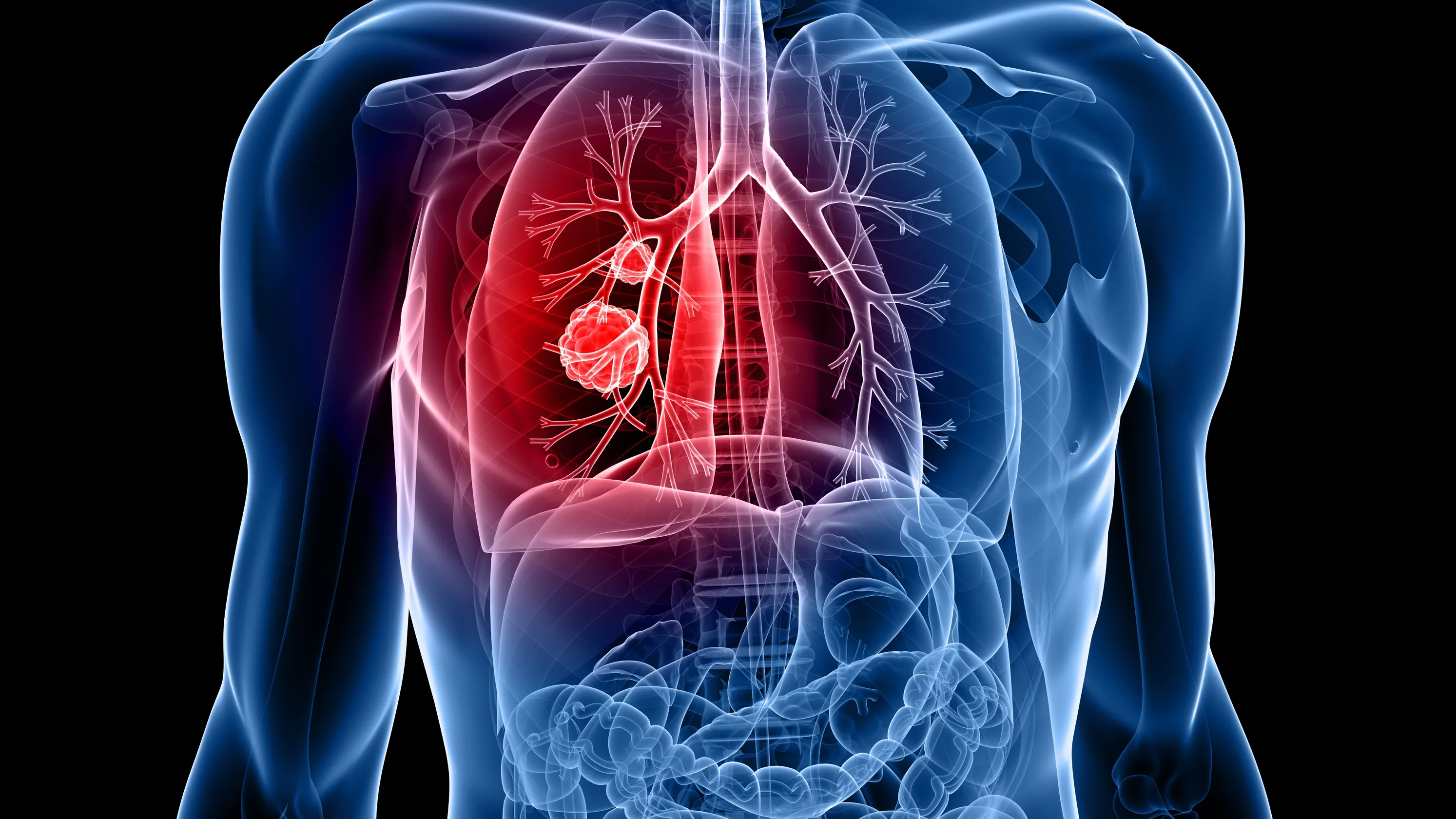 Lung Cancer Treatment in Dwarka